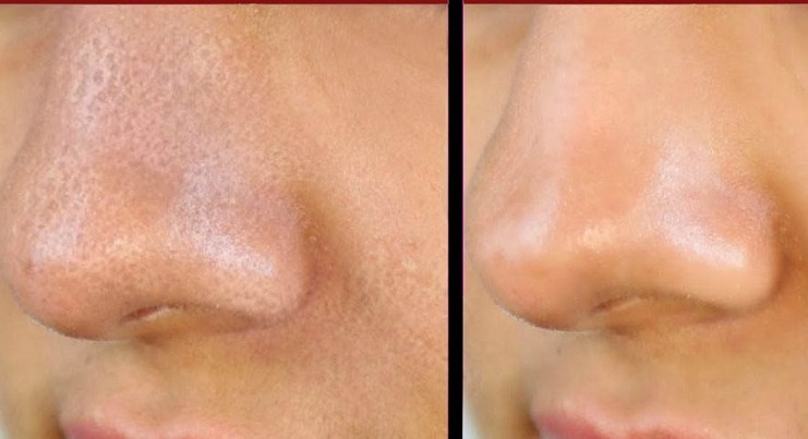 Cilt gözenekleri nasıl sıkılaşır?