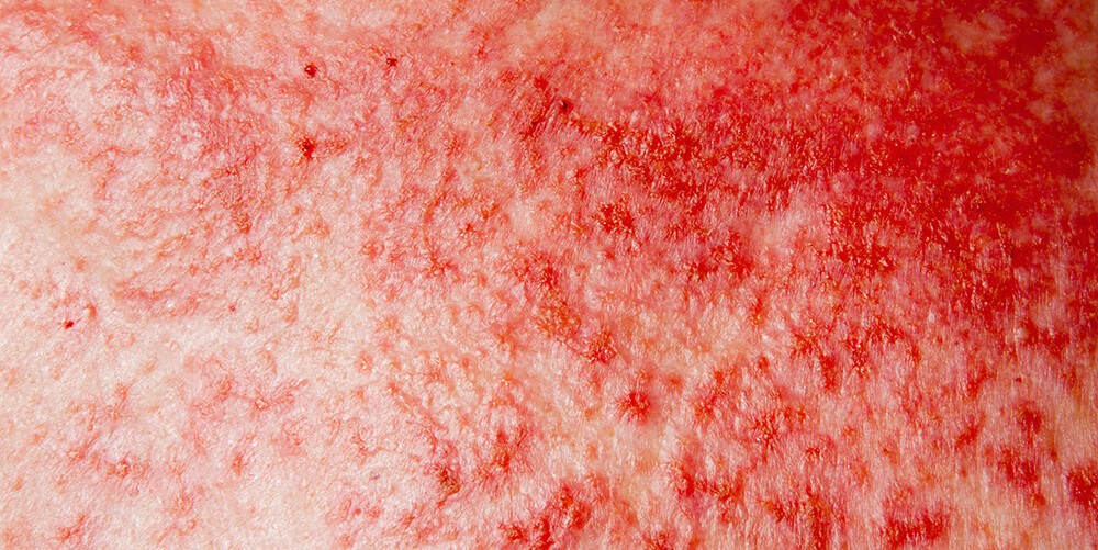 Cilt kanseri neden olur, belirtileri neler?