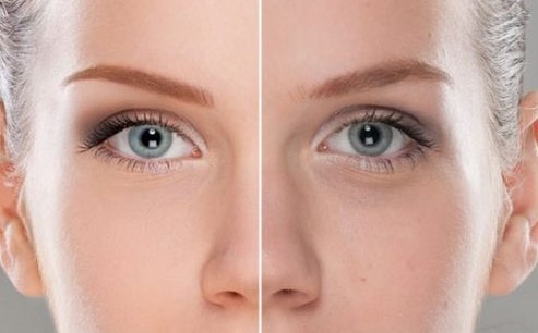 Cilt tonu nasıl eşitlenir? Cilt tonu bozuklukları için maske