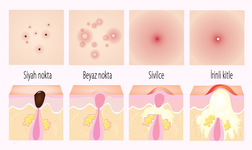 Cilt ve gözenek temizliğinde dikkat edilmesi gerekenler