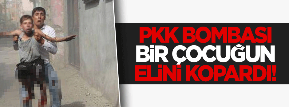 Cizre'de PKK bombası bir çocuğun elini kopardı!
