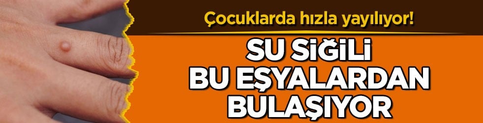 Çocuklarda hızla yayılıyor! Su siğili bu eşyalardan bulaşıyor
