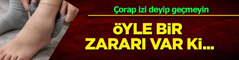 Çorap izi deyip geçmeyin! Çoğu kişi farkına bile varmıyor: Karaciğer ve böbrekler iflas ediyor olabilir