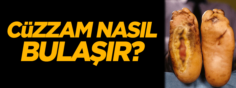 Cüzzam nasıl bulaşır?