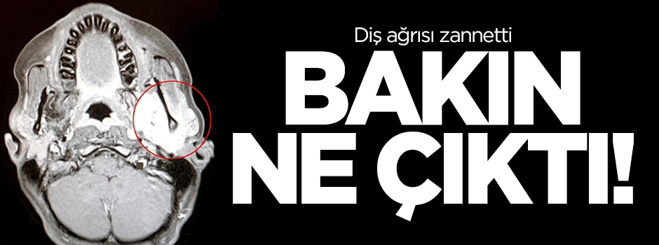 Diş ağrısı zannetti, bakın ne çıktı!