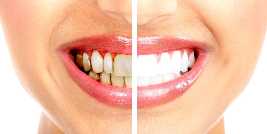 Diş taşından kurtulmanın en etkili yolu