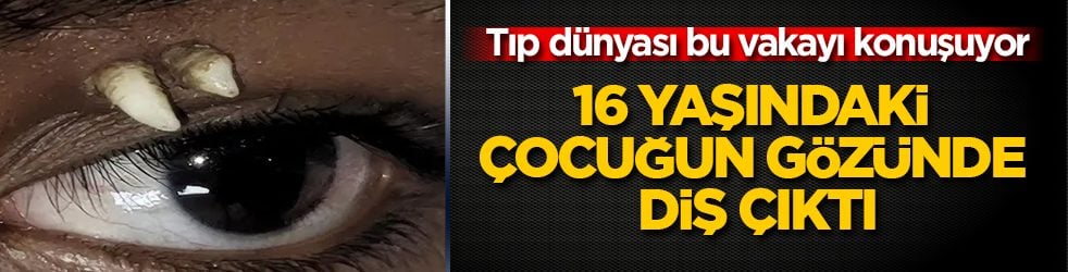 Doktorlar şoke oldu, tıp dünyası bu vakayı konuşuyor: 16 yaşındaki çocuğun gözünde diş çıktı