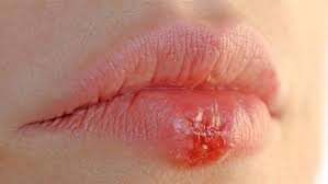 Dudak uçuğu için hangi doktora gidilir?