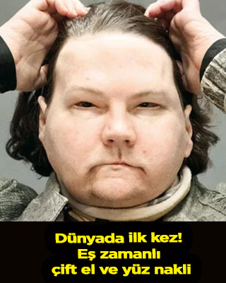 Dünyada ilk kez! Eş zamanlı çift el ve yüz nakli oldu: Tuhaf bakıyorlar