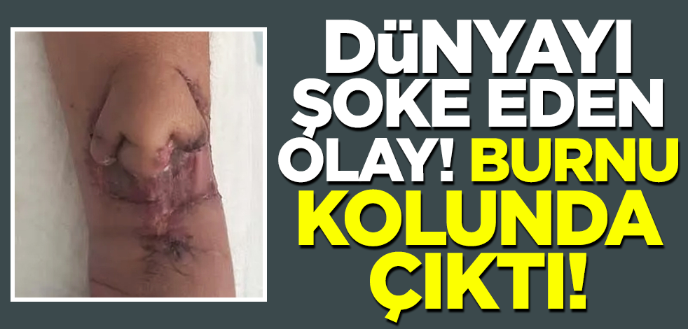 Dünyayı şoke eden olay! Burnu kolunda çıktı
