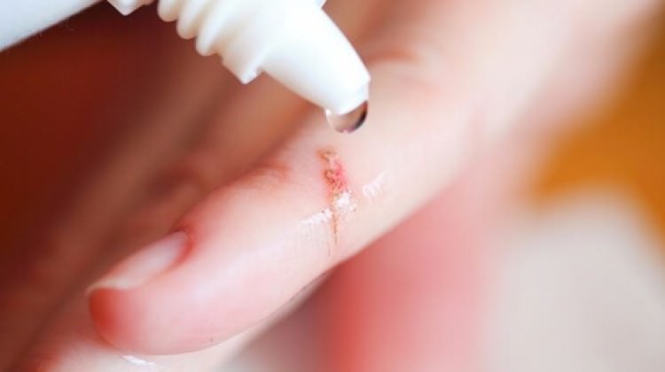 El yaraları nasıl geçer?