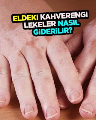 Eldeki kahverengi lekeler nasıl giderilir? Bakım için en iyi krem