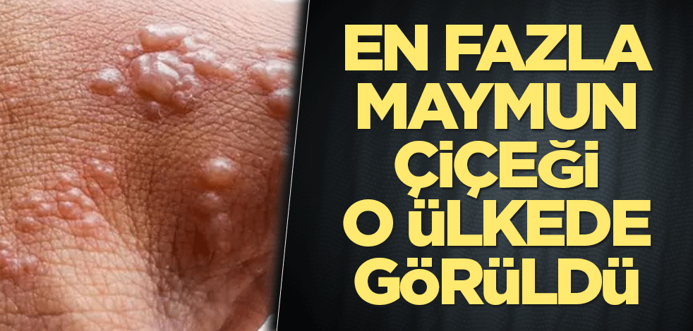 En fazla maymun çiçeği vakasının görüldüğü ülke açıklandı