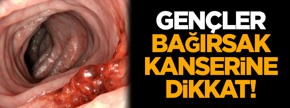 Gençler, bağırsak kanserine dikkat!