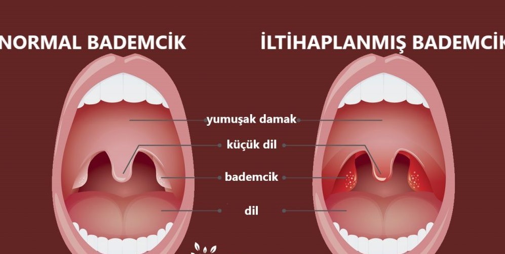 Geniz eti iltihabı nedir, nasıl tedavi edilir?