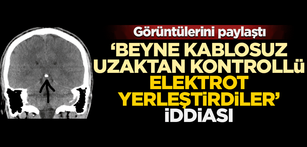 Görüntülerini paylaştı! ‘Beyne kablosuz uzaktan kontrollü elektrot yerleştirdiler’ iddiası