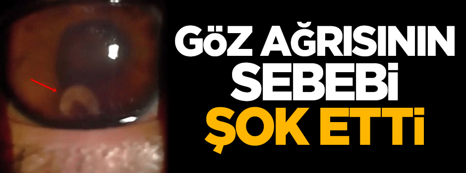 Göz ağrısının sebebi şok etti!
