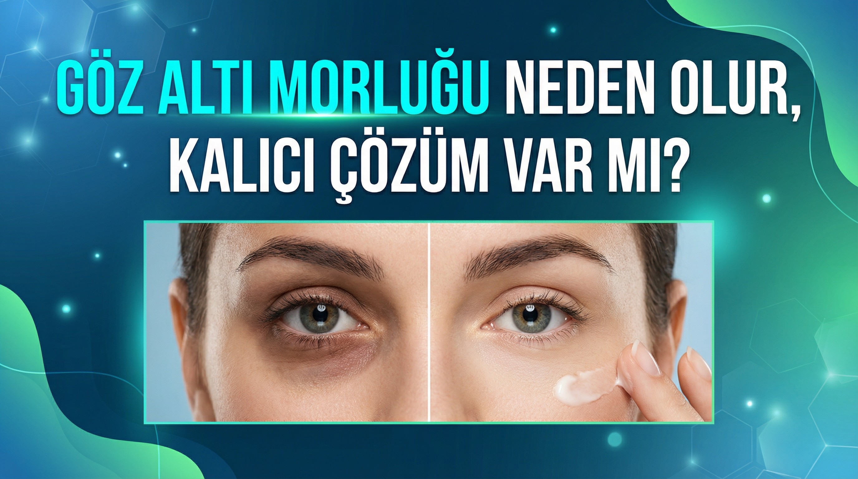 Göz altı morluğu neden olur, kalıcı çözüm var mı?