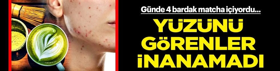 Günde 4 bardak matcha çayı içiyordu: Belirtiler alarm verdi! O sorunu görenler inanamadı... Bakın neler çıktı