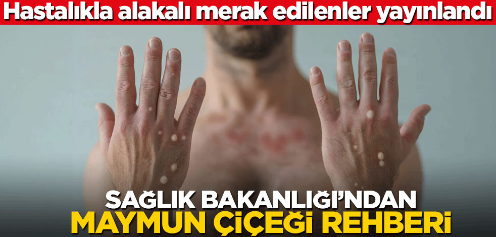 Hastalıkla alakalı merak edilenler yayınlandı! Sağlık Bakanlığı’ndan maymun çiçeği rehberi