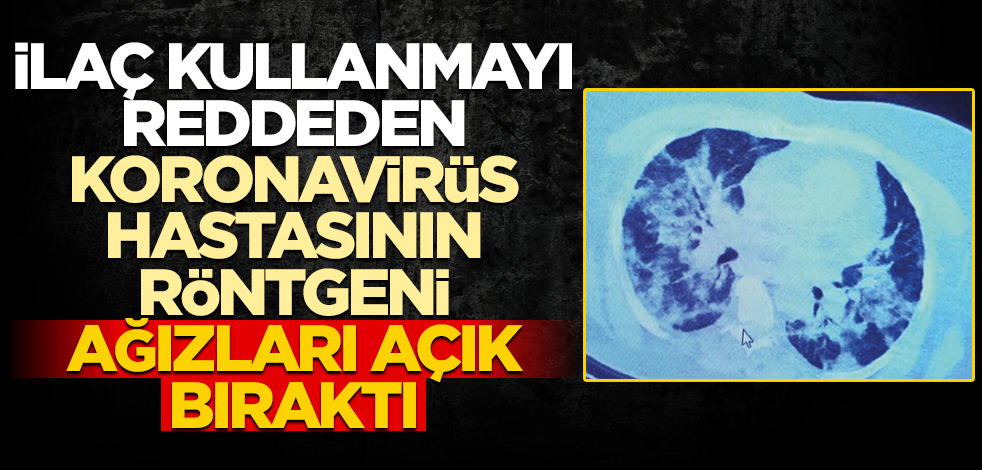 İlaç kullanmayı reddeden koronavirüs hastasının röntgeni ağızları açık bıraktı