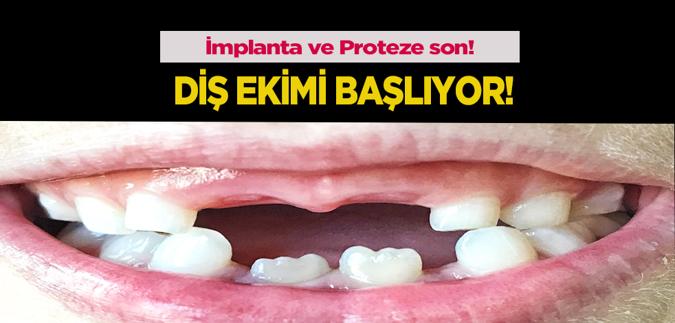 İmplanta ve Proteze son. Duymadık demeyin 'diş ekimi' başlıyor!