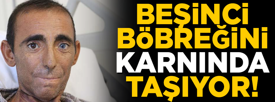 İnanılmaz hikaye! Beşinci böbreğini karnında taşıyor