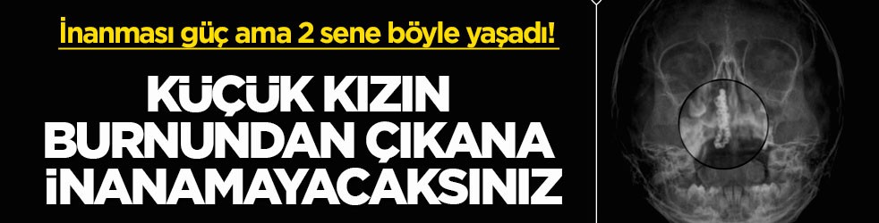 İnanması güç ama 2 sene böyle yaşadı! Küçük kızın burnundan çıkana inanamayacaksınız