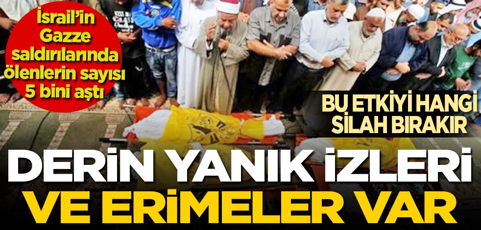 İsrail'in Gazze saldırılarında ölenlerin sayısı 5 bini aştı: Bu etkiyi hangi silah bırakır: Derin yanık izleri ve erimeler var