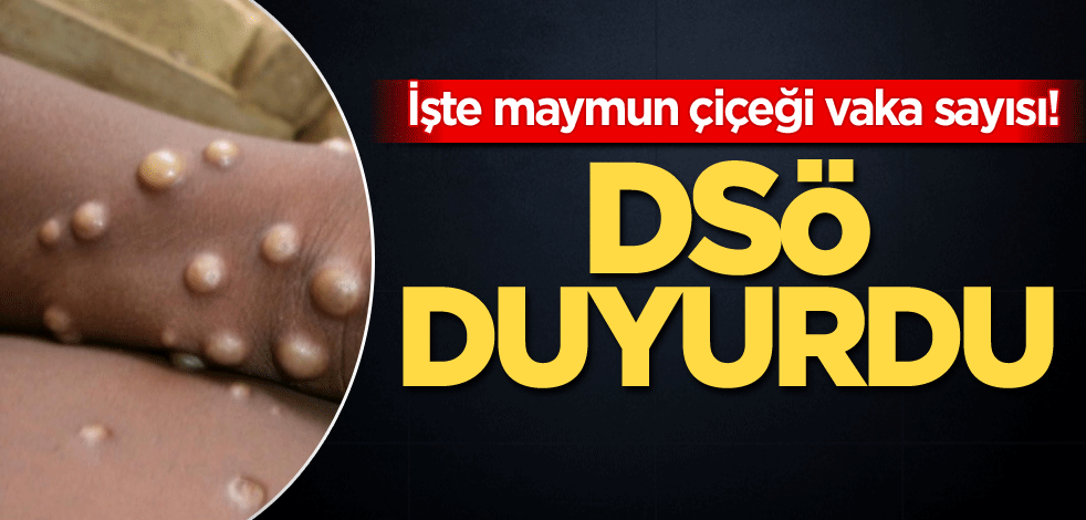 İşte maymun çiçeği vaka sayısı! DSÖ duyurdu