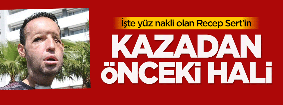 İşte yüz nakli olan Recep Sert'in kazadan önceki hali
