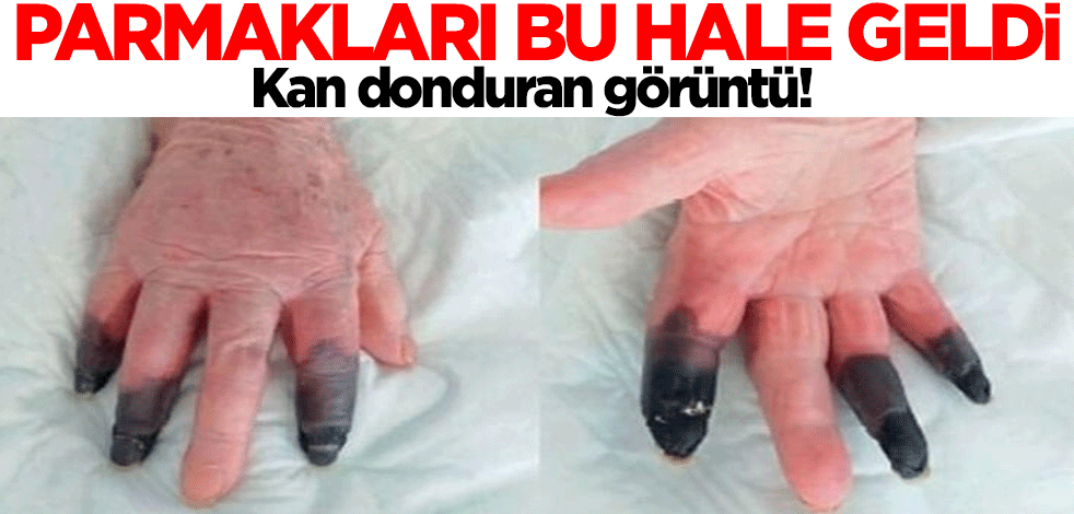 Kan dondurdu! Koroanavirüs parmaklarını bu hale getirdi