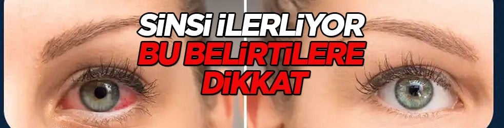 Kapalı açılı glokom nedir? Güvenlik önlemi için hangi tedbirleri alınmalı merak edildi...