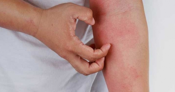 Kaşıntı neden olur? Kaşıntı hangi hastalığın habercisidir?