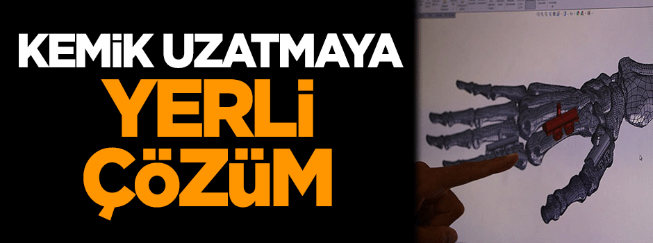 Kemik uzatmaya yerli çözüm