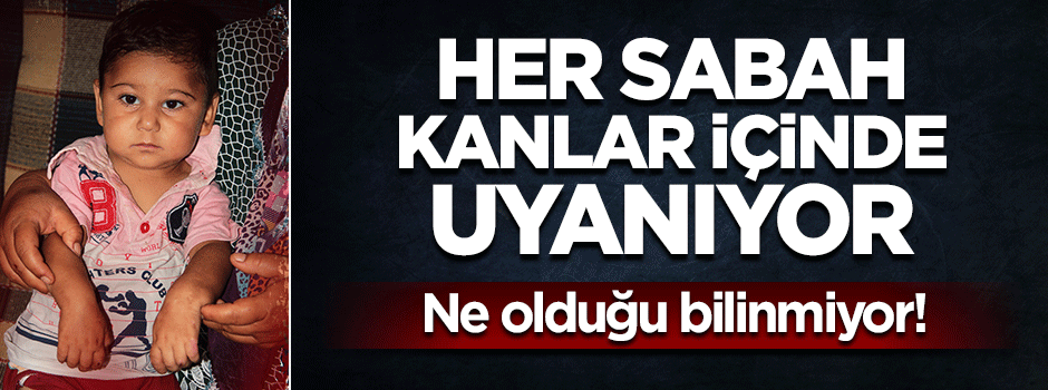 Kendini ısıran bebeğin ailesi zor durumda