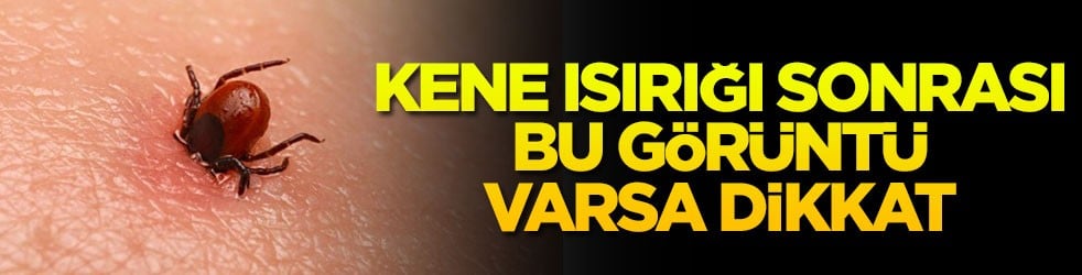 Kene ısırığı sonrası bu görüntü varsa dikkat