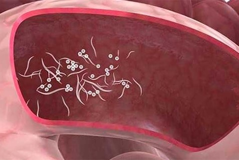 Kıl kurdunun bitkisel tedavisi