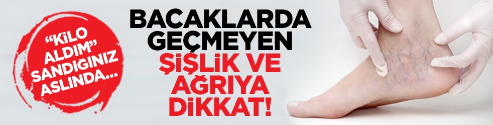 “Kilo aldım” sandığınız aslında… Bacaklarda geçmeyen şişlik ve ağrıya dikkat!