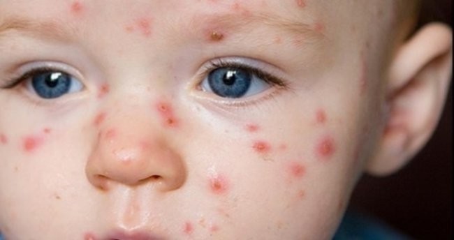 Kızamığın belirtileri nelerdir? Tedavisi nasıl yapılır?