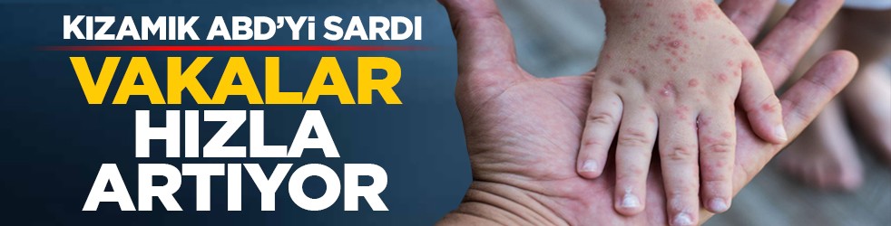 Kızamık ABD’yi sardı: Vakalar hızla artıyor