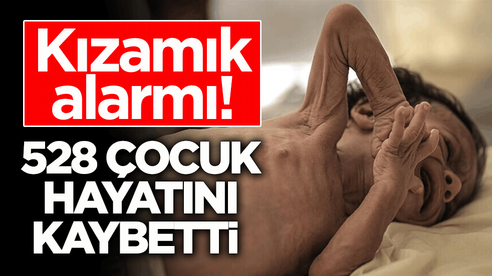 Kızamık alarmı! 528 çocuk hayatını kaybetti 