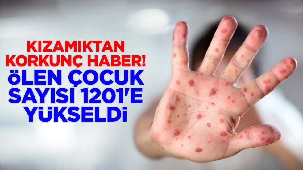 Kızamıktan korkunç haber! Ölen çocuk sayısı 1201'e yükseldi