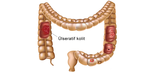 Kolit hastalığı nedir? Ülseratif kolit neden olur?