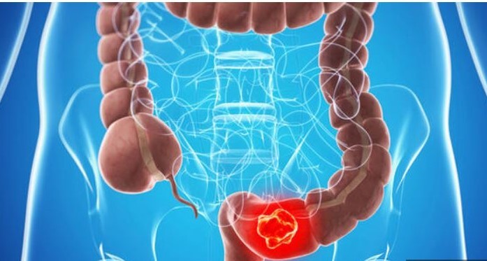 Kolon kanseri nedir? | Kolon kanseri bitkisel tedavisi nasıl uygulanır?