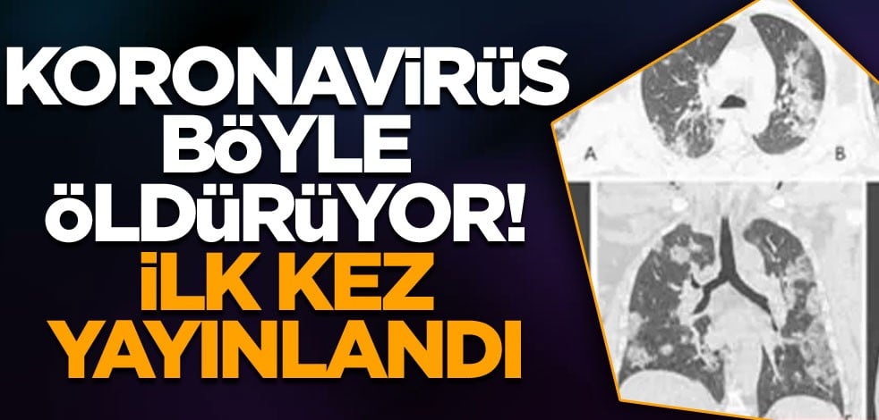 Koronavirüs böyle öldürüyor!