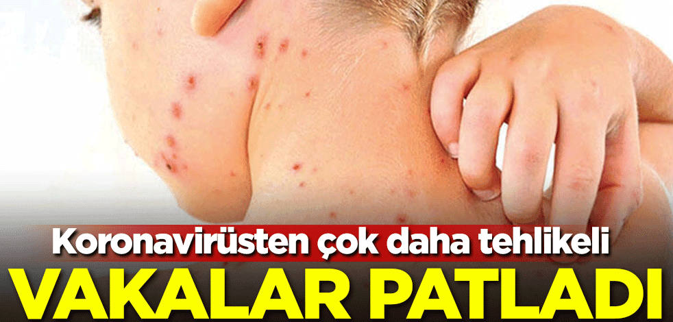 Koronavirüsten çok daha tehlikeli! Vakalar patladı