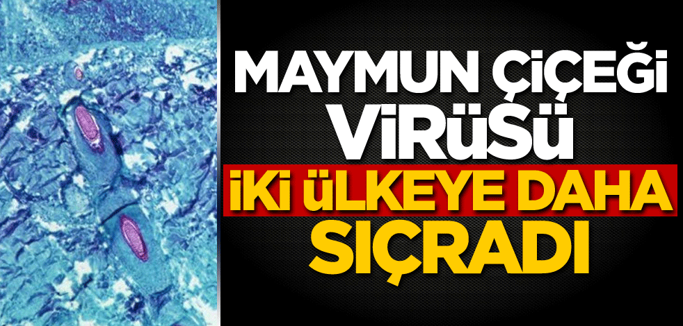 Maymun Çiçeği virüsü iki ülkeye daha sıçradı