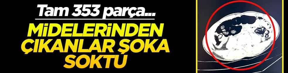 Midelerinden çıkanlar şoka soktu! Tam 353 parça....