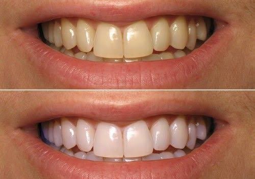 Oil Pulling nedir? Ne işe yarar?